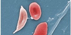 Normal blood cells next to a sickle blood cell, coloured scanning electron microscope image