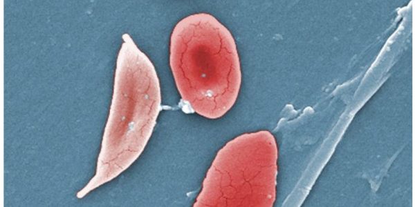 Normal blood cells next to a sickle blood cell, coloured scanning electron microscope image
